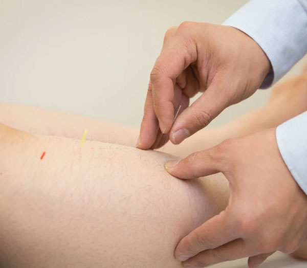 acupuncture treatment in Pascoe Vale acupuncture treatment in Pascoe Vale